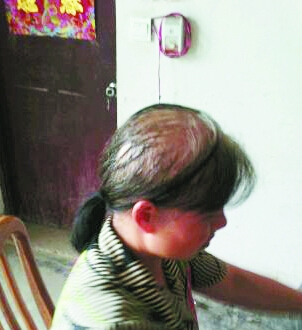 40岁<em>女子</em>自行买染发剂染发,导致<em>头发大把</em>脱发